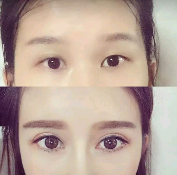 看看你的眼睛需要开眼角吗