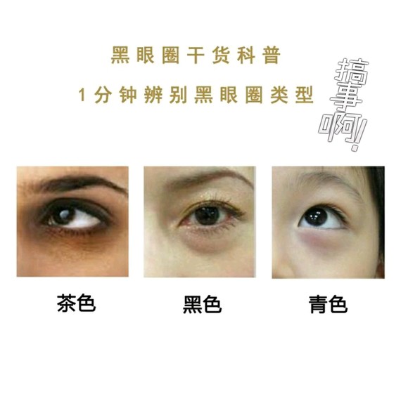 如何判断自己是血管型黑眼圈 新氧美容整形