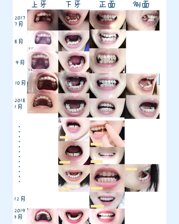 带牙套1~12月变化图图片