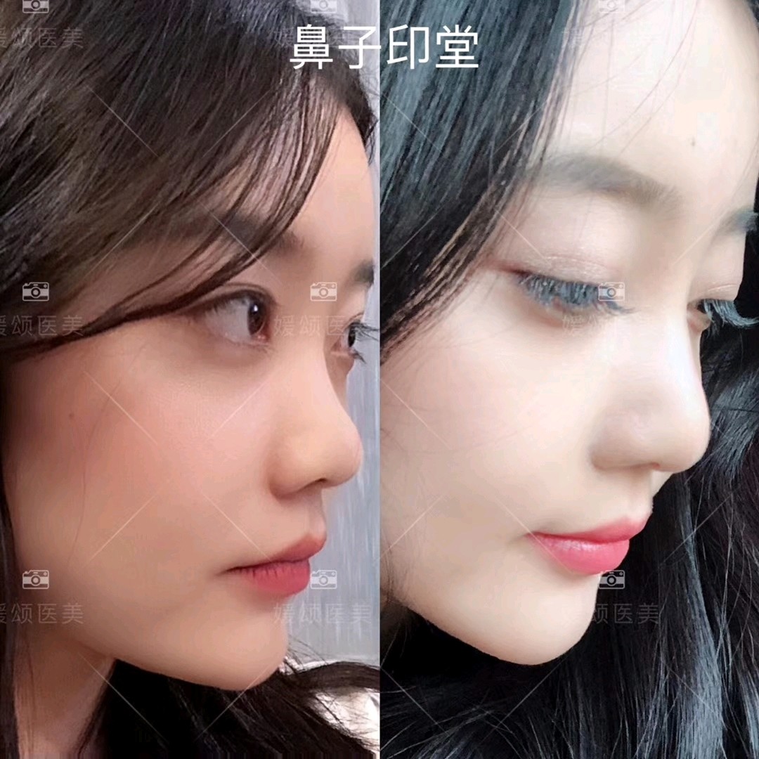 鼻子印堂有多重要