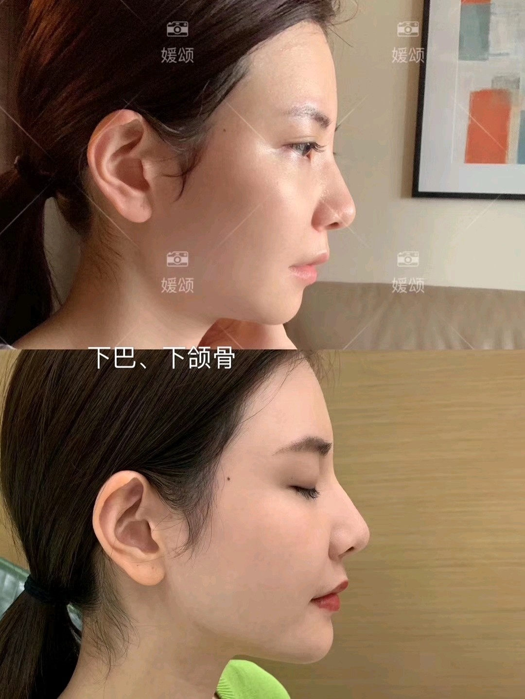 小星星前天晚上打的下巴下颌骨对比