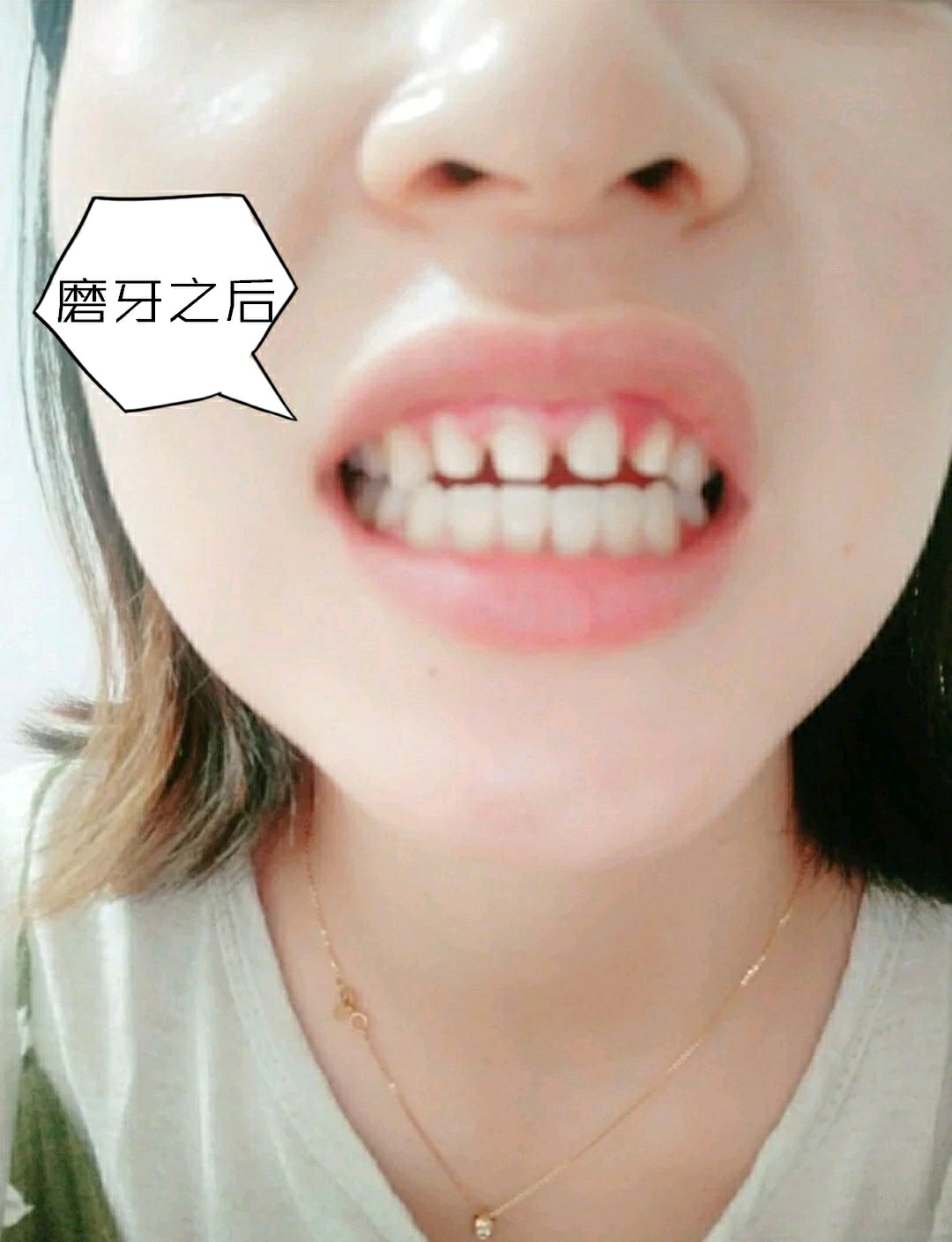 曾几何时,我一直以为自己的龅牙只能够通过牙齿矫正才可以解决.