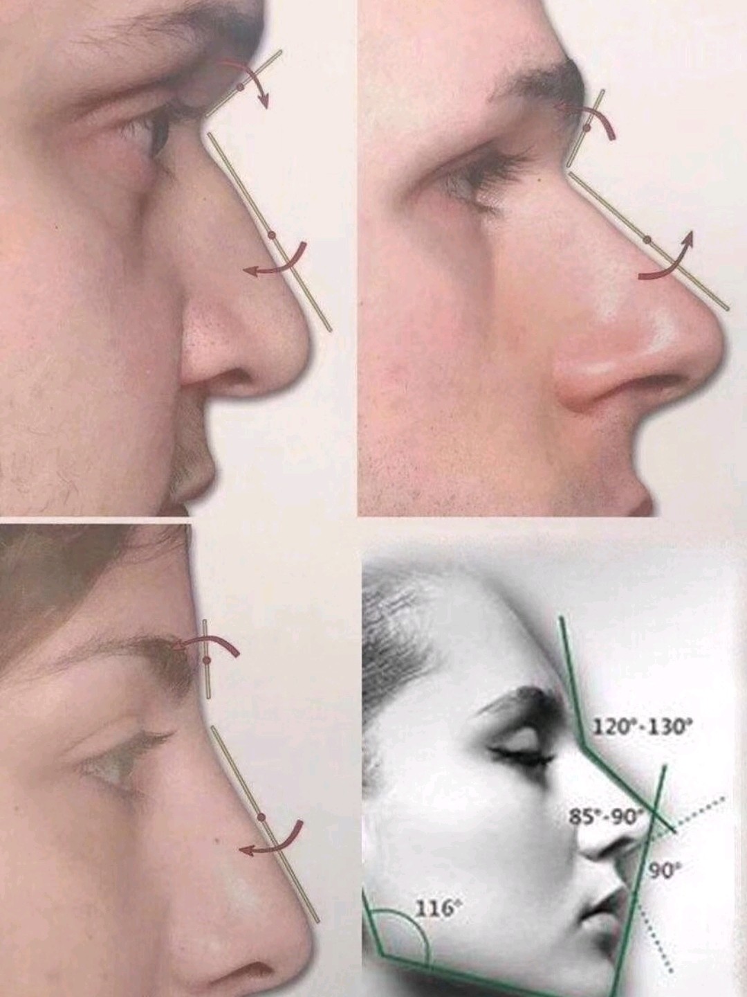 91如图所示的角度叫鼻额角1:它是眉间点到鼻根点的线_圈子-新氧美容