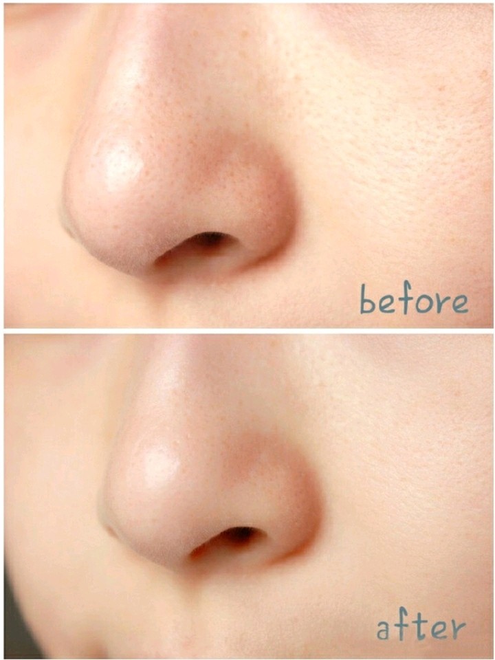 点阵激光去黑头真的可以永久有效么