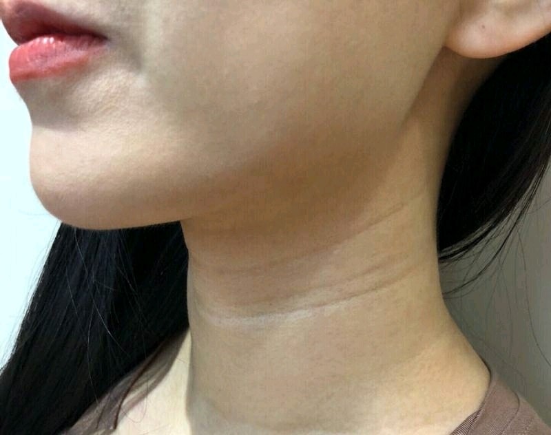 "嗨体"祛颈纹,别让脖子暴露了你的年龄