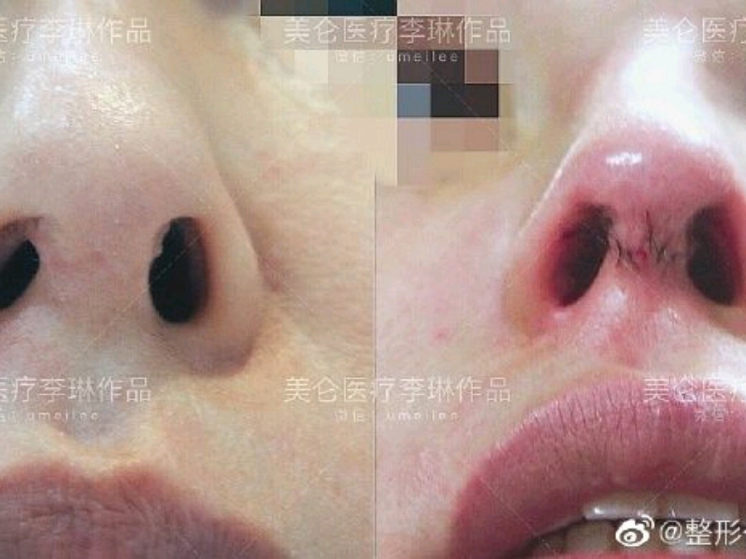 肋骨鼻,术后短鼻没有纠正,还造成鼻背假体偏斜,鼻孔内切口瘢痕增生