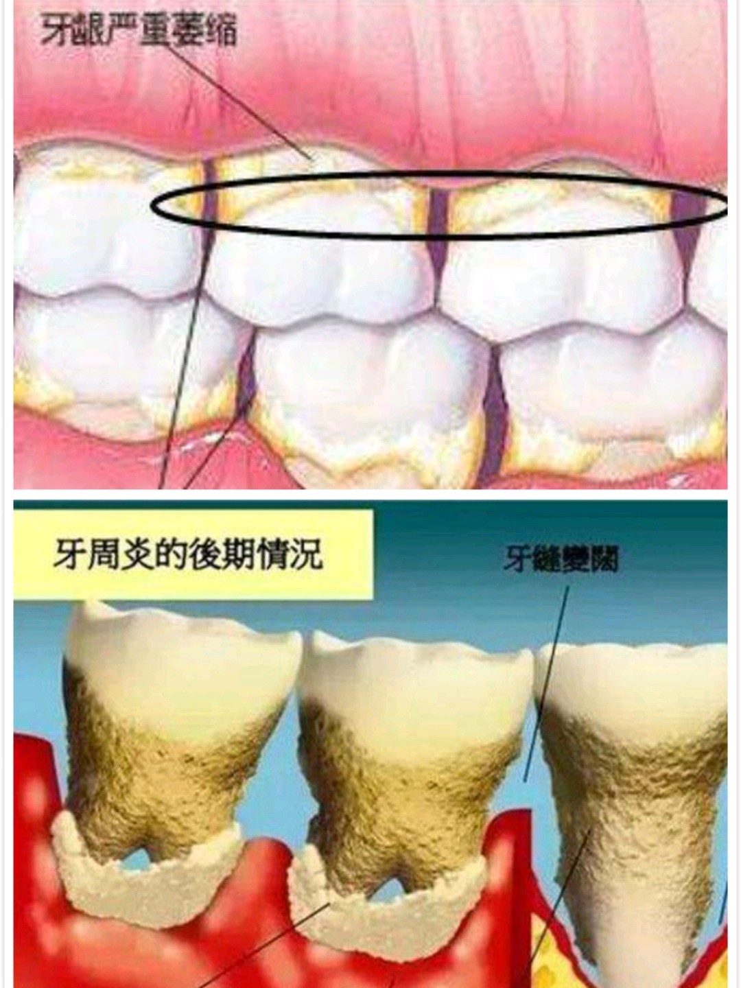 关于牙龈萎缩你需要知道的一切