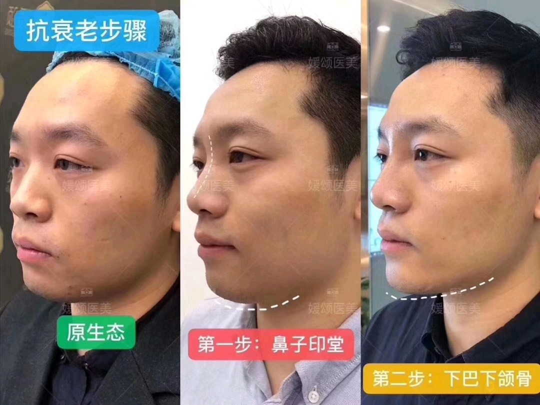 【新出炉男士案例】鼻子 印堂 下巴 下颌_圈子-新氧美容整形
