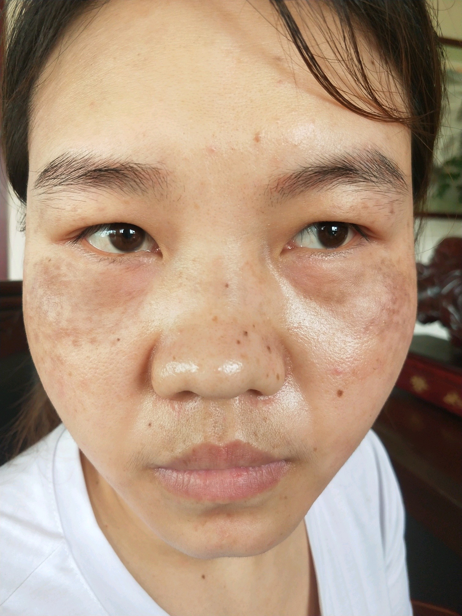 真皮斑准备去除中