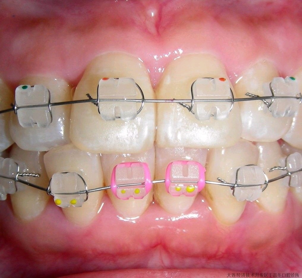 92分享我的陶瓷托槽矫正,离摘牙套更进一步03陶瓷托槽_圈子-新氧