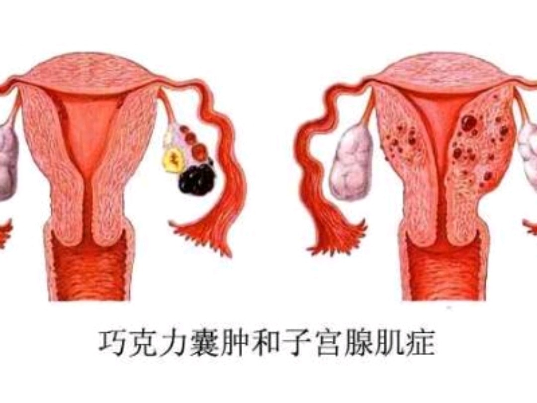 女性值得收藏,什么是巧克力卵巢囊肿?如何治疗它?