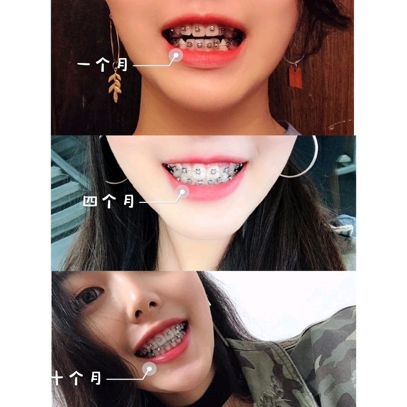 牙套女孩整容级变形计|想要变美再老都不晚