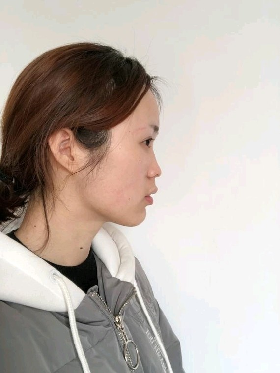 亲身经历告诉你,隆鼻的危害有很多._圈子-新氧