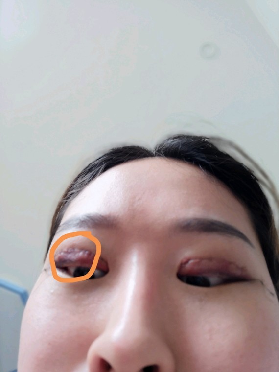 在北京玲珑梵宫由张殿祥做的双眼皮修复手术做失败了