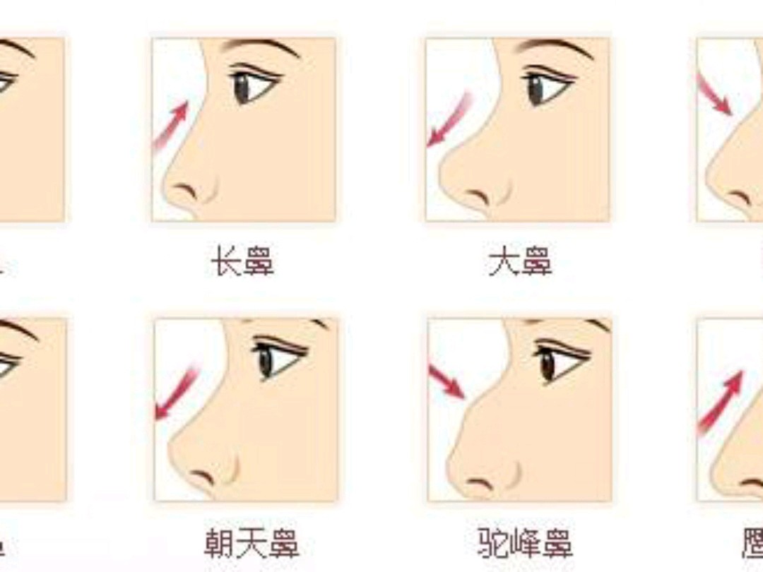 手术,但是毕竟是面部五官之首,一个好看的鼻子对人的改变是非常重要的