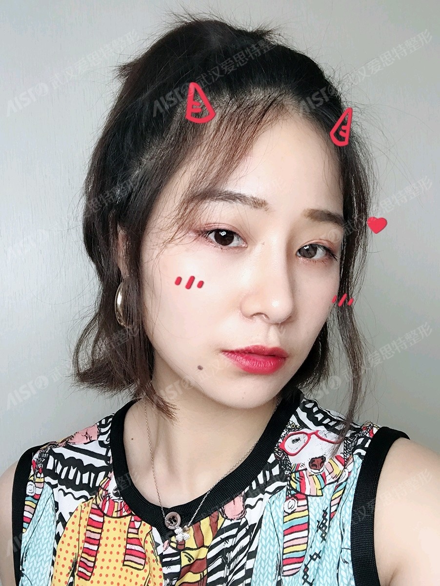 为什么垫鼻背首选膨体?166,可以用自体软_圈子-新氧美容整形