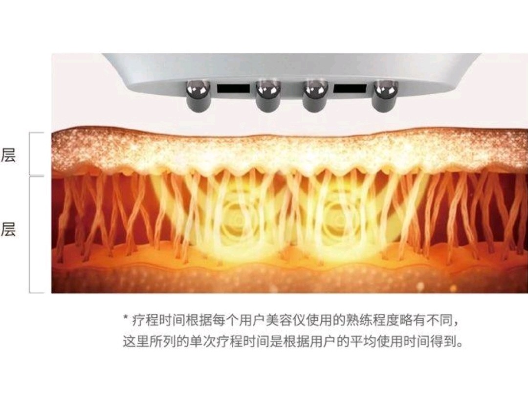 首页 此页面仅支持预览 Avatar Maryfairy玛丽仙 29篇日记 Rf射频 此技术在医疗美容界广泛应用已经有多年的历史 基于其非侵入性以及良好的治疗效果 至今一直深受皮肤科医生和消费者的喜爱 著名美容皮肤科专家crystal老师 从事皮肤科临床诊治