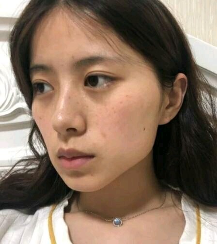 99我这张六边形的脸居然能用脂肪填充起来,95听说曹家_圈子-新氧