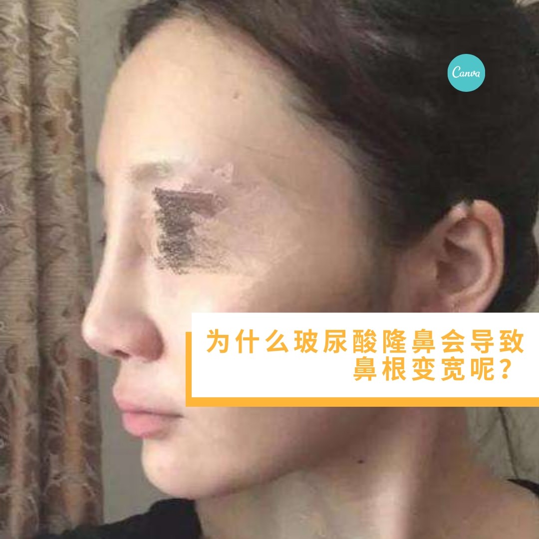 为什么玻尿酸隆鼻会导致鼻根变宽呢?