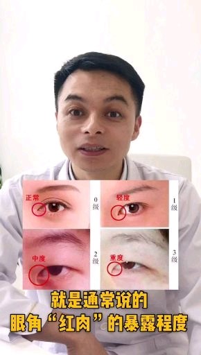内眼角分3度,以眼角"红肉"暴露_圈子-新氧美容整形