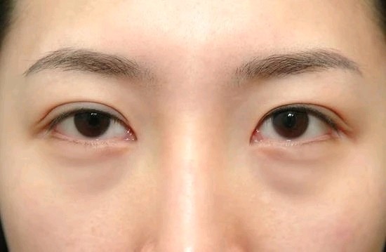 还可表现为外眦位置下移,下睑缘与眼球贴合不紧密,下泪点外移等.