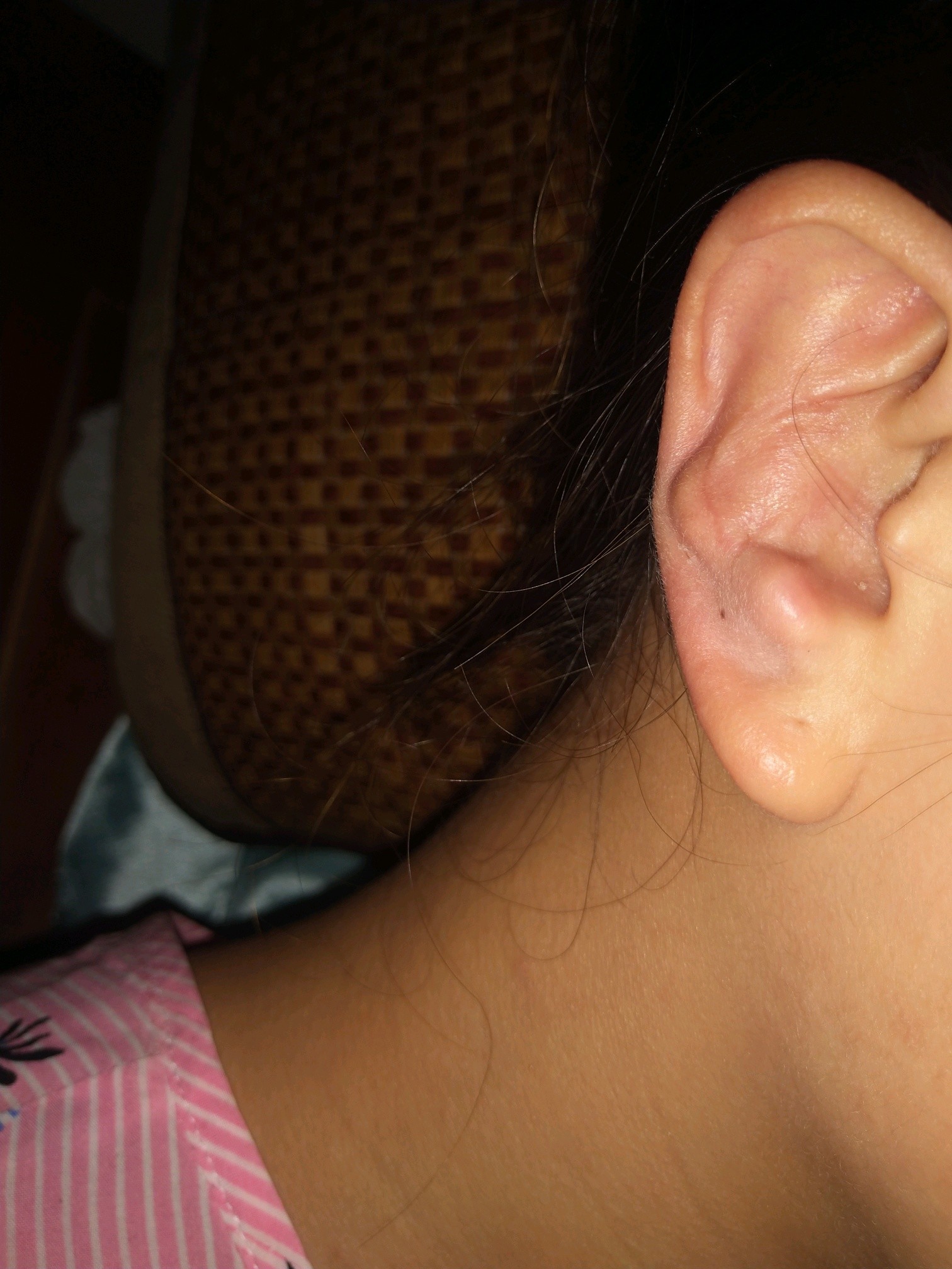 取耳软骨取变形到现在已经有1年多了我想问下这个可以做修复吗耳朵
