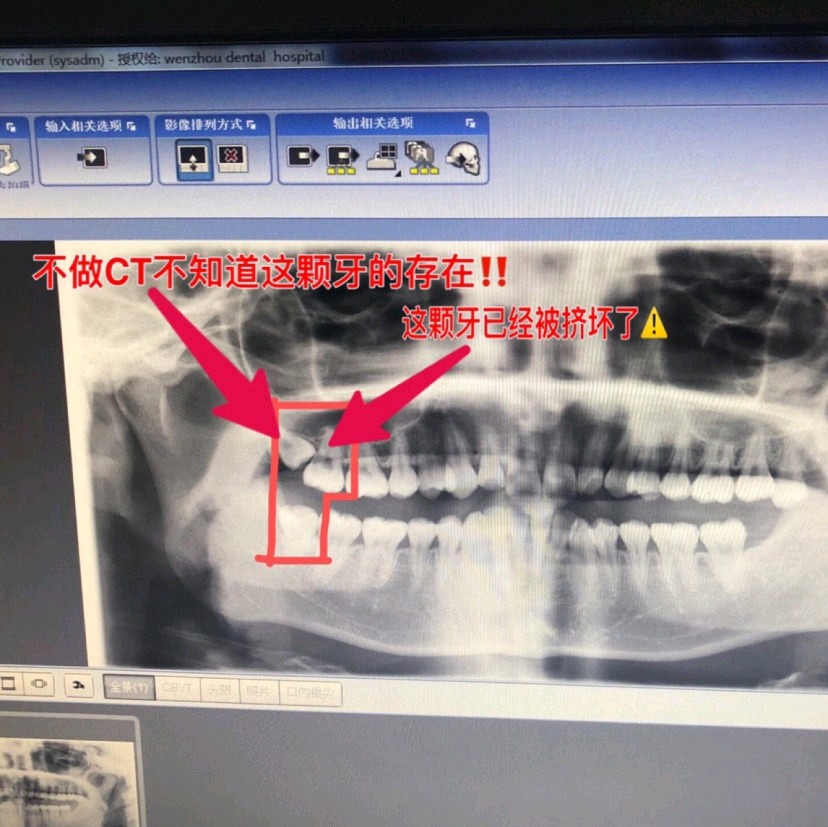 如果智齒有過發炎/疼痛/不適感,考慮智齒有可能是阻生齒或者長得不正