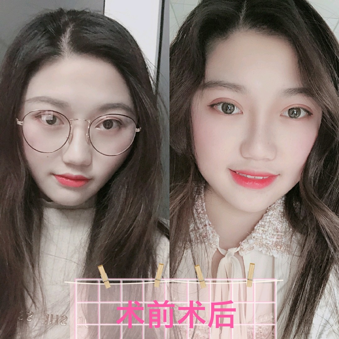 icl晶体植入后,不仅矫正了近视,眼睛也越来越有神!