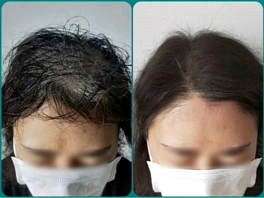 女士头发稀疏纹发后效果对比图!