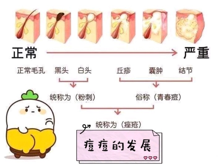 你长的痘痘不止一种,但果酸祛痘一招搞定