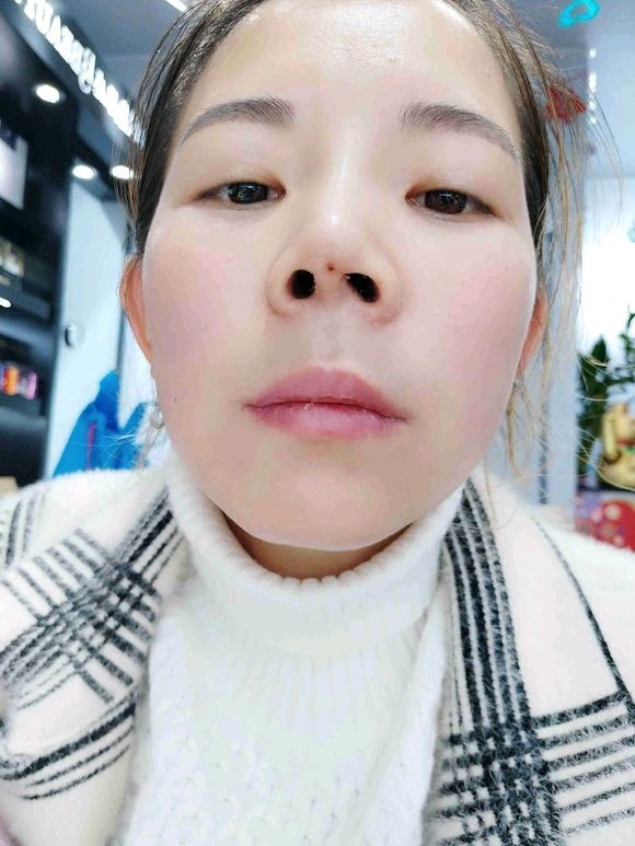 细数线雕隆鼻的那些事儿