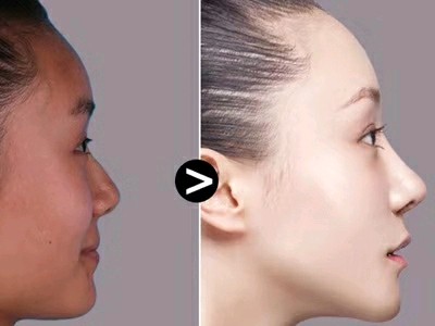 强基固本,"鼻"9615所成,拉斐尔隆鼻91_圈子-新氧美容整形