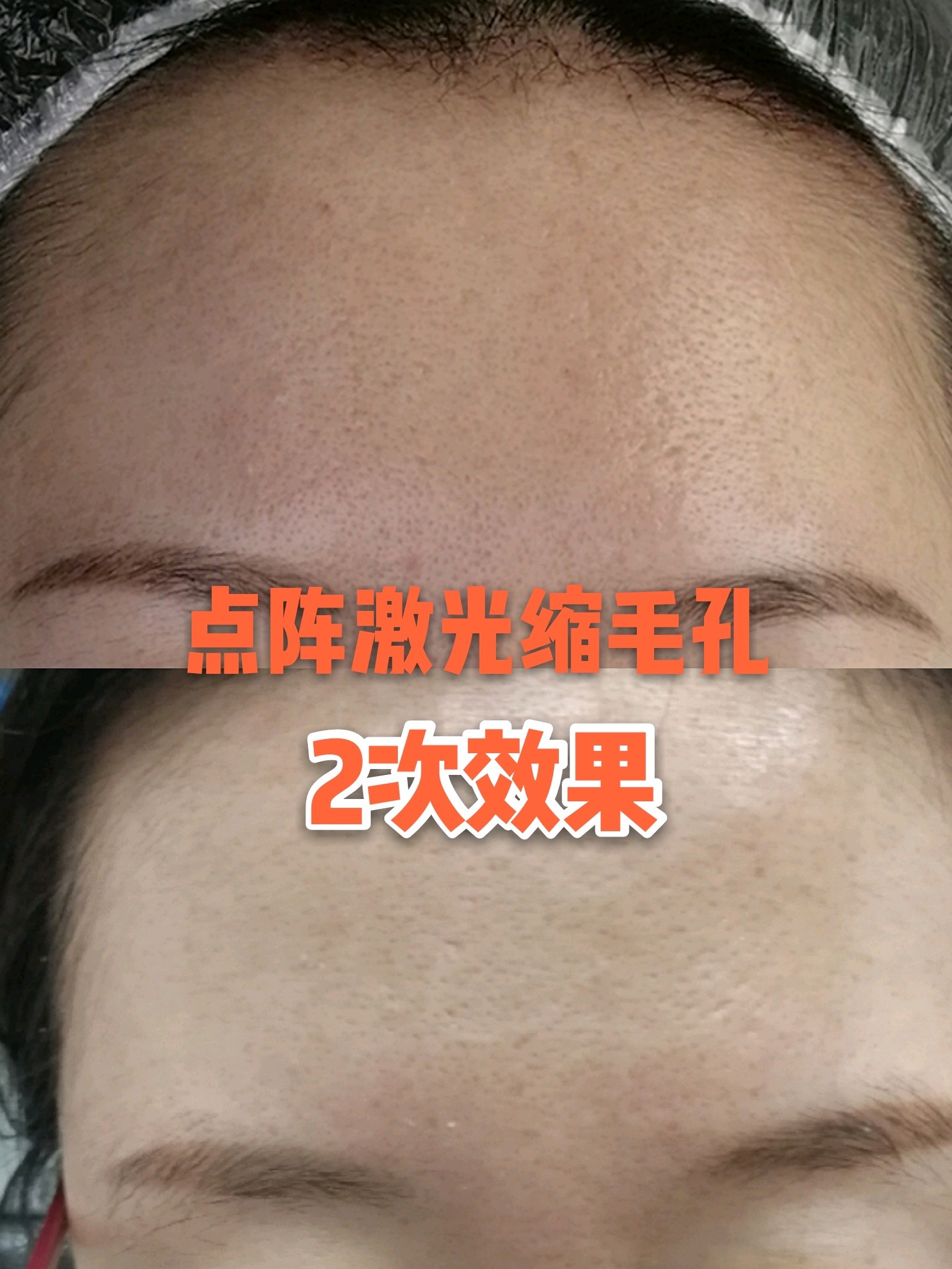 点阵激光缩毛孔术后4天