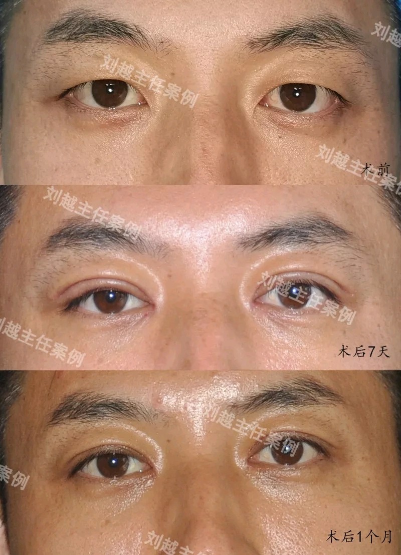 男生双眼皮案例分享小眼睛男生做完双眼皮啥效果?