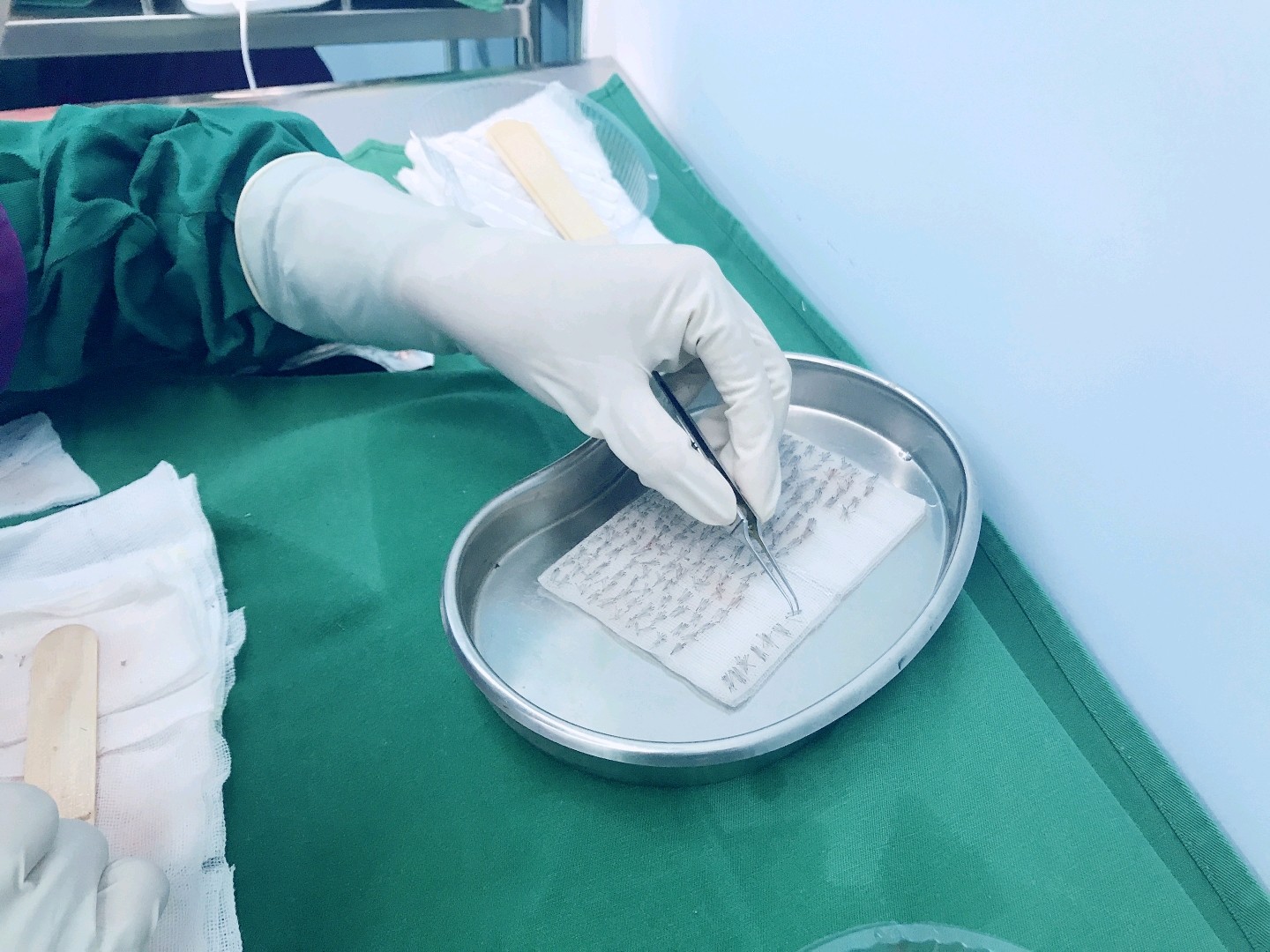 毛囊的成活率97取决于提取毛囊控制的深度,分离毛囊的_圈子-新氧