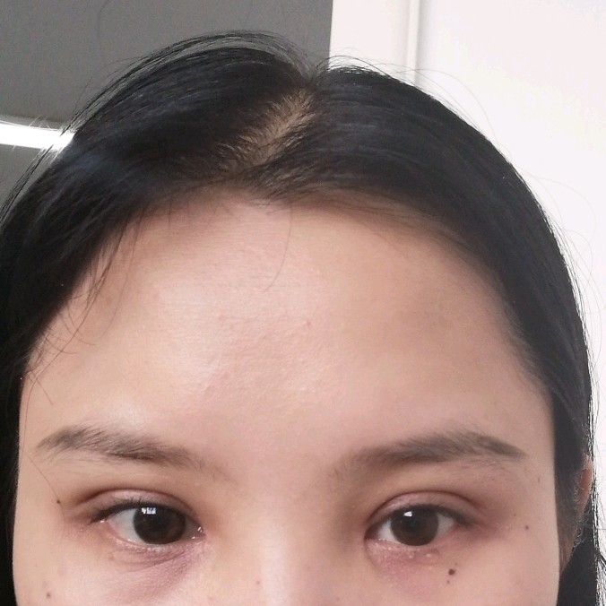 是不是双眼皮失败了都一个月了,太深了双眼皮一点都不_圈子-新氧美容