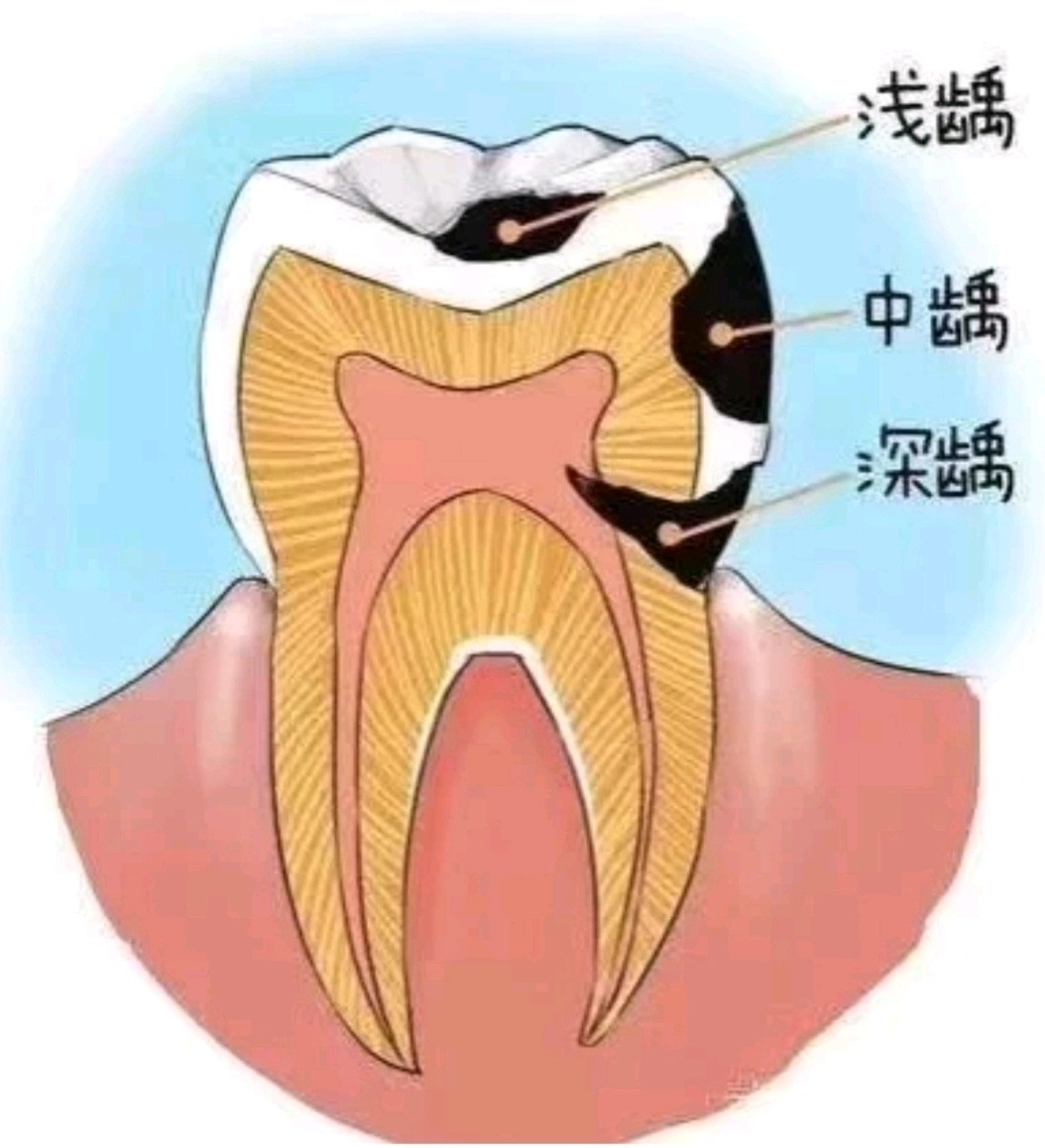 龋齿如何辨别呢婴儿奶瓶龋如何防止呢