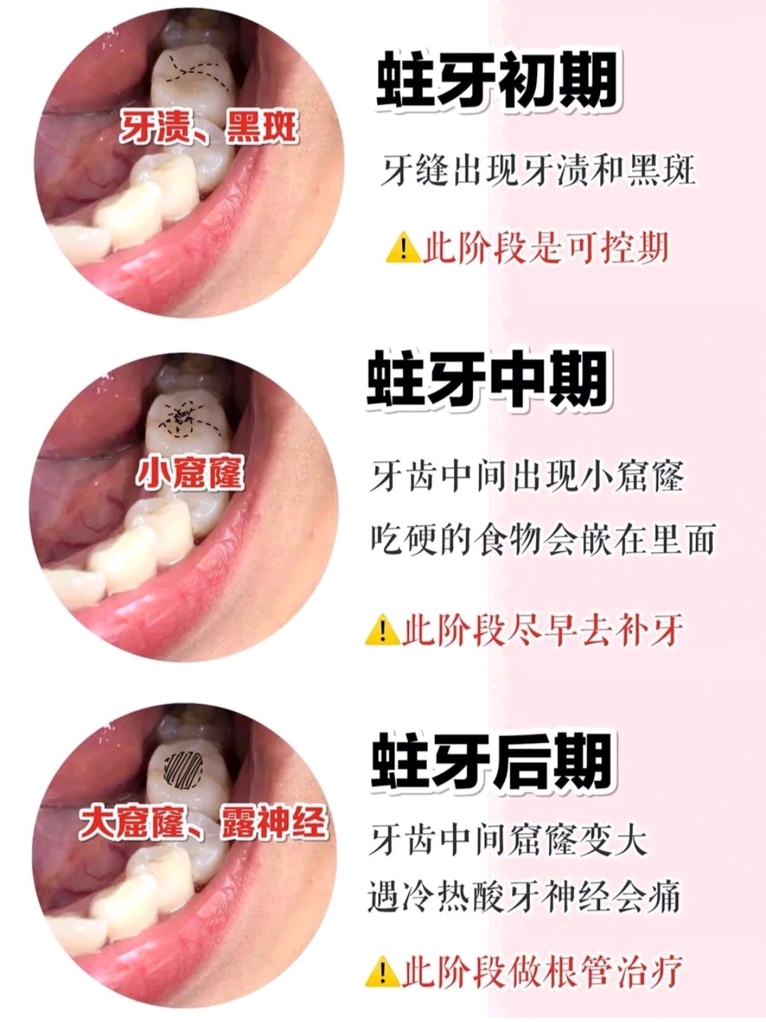 龋齿如何辨别呢婴儿奶瓶龋如何防止呢