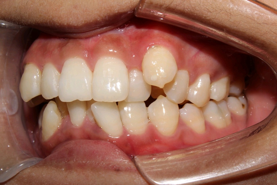 [cp]看照片你就知道拥有两排整齐的牙齿是多么重要