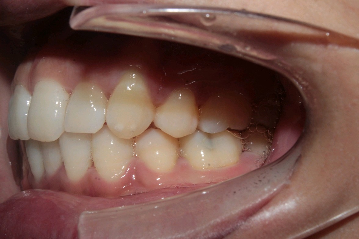 [cp]看照片你就知道拥有两排整齐的牙齿是多么重要_圈子-新氧美容整形