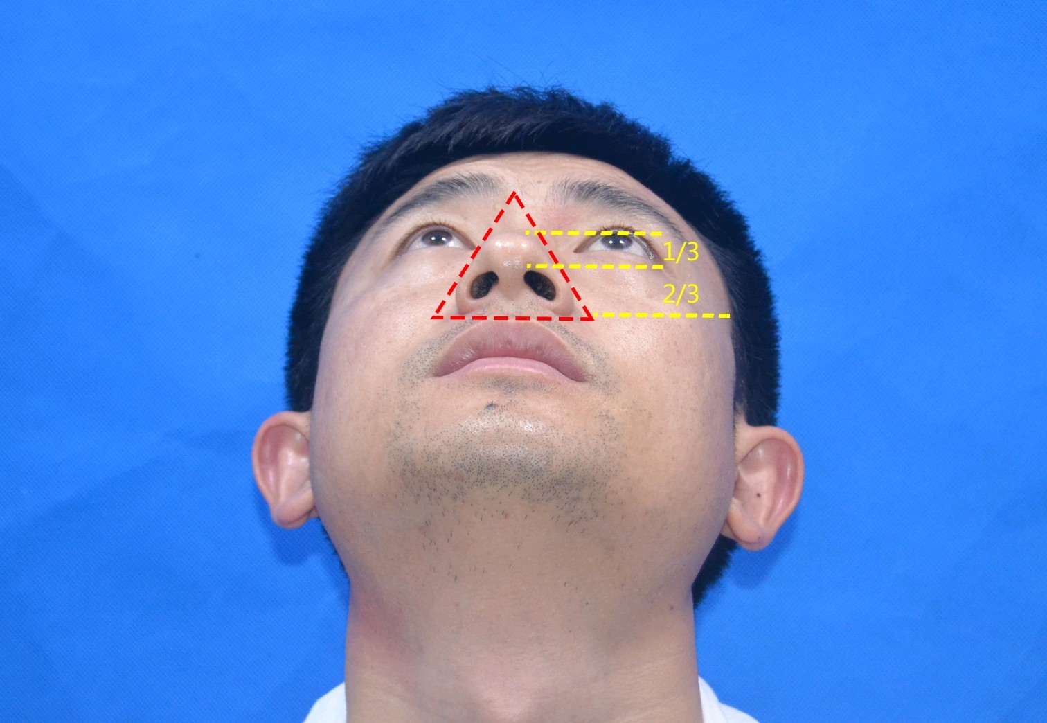 94 广州艺美李闯院长在线问诊专贴,实时回复答疑,定制化分析,让你美