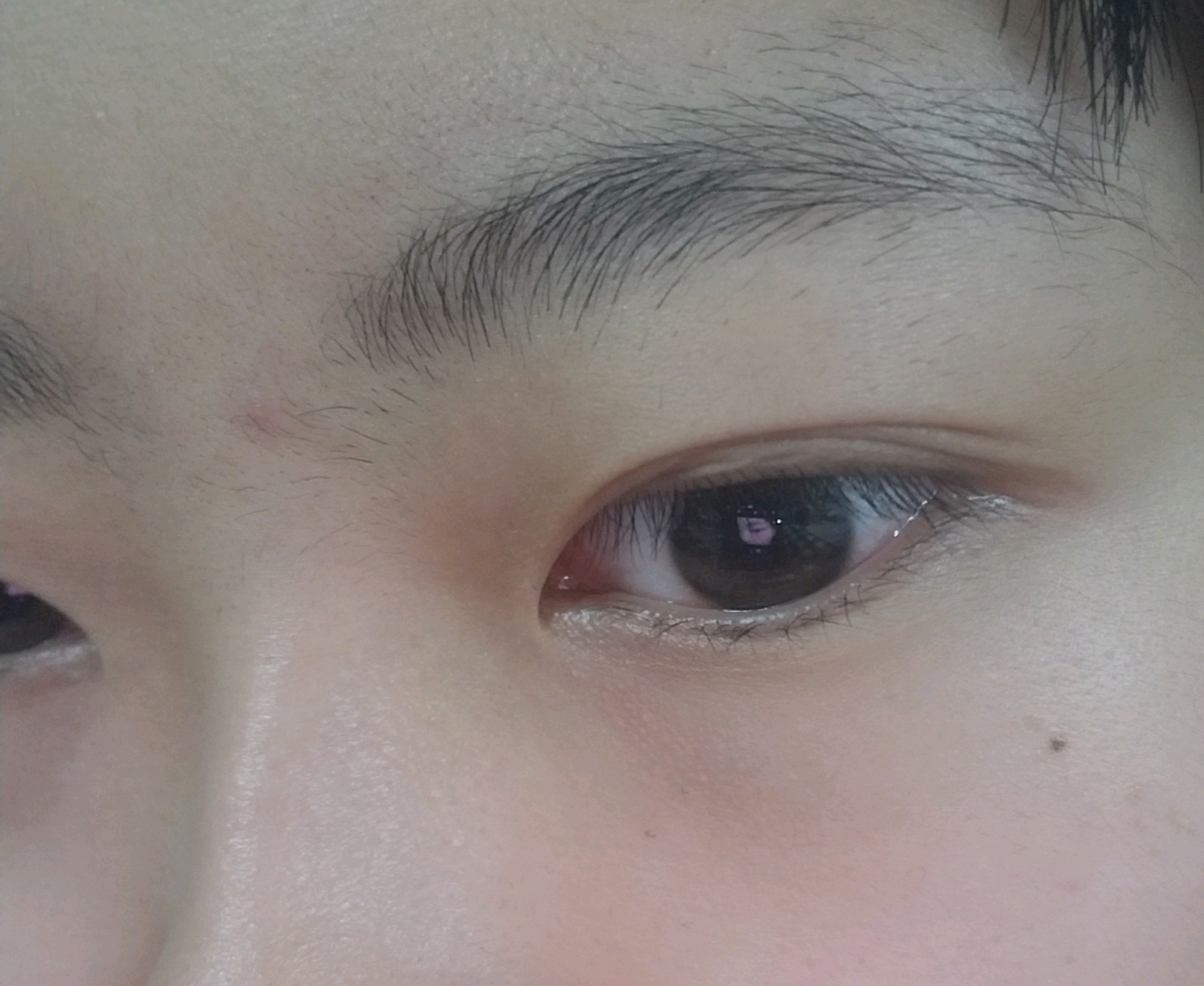 眼轮匝肌对于双眼皮的形成有多重要？_双眼皮手术_双眼皮手术治疗介绍 - 好大夫在线