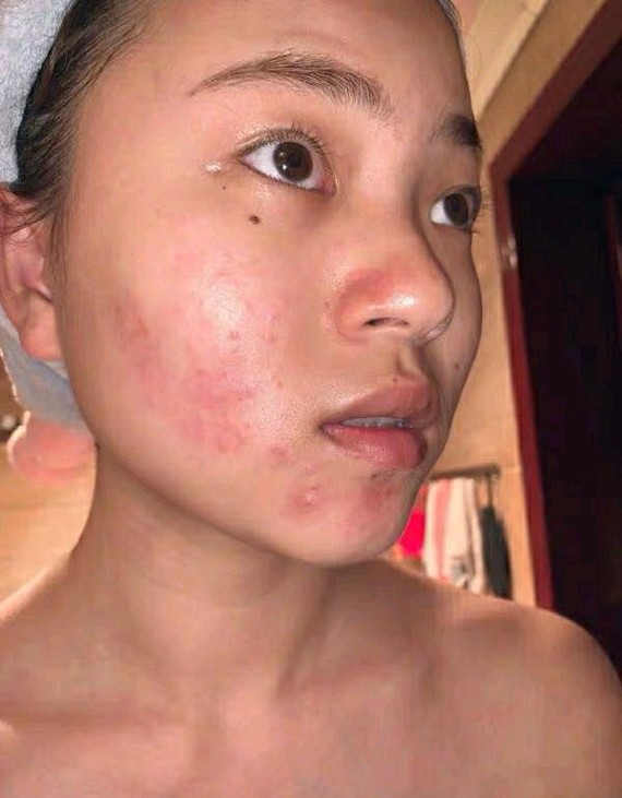 以前的脸让我觉得真的很痛苦06满脸红肿,痘痘横生,甚_圈子-新氧美容