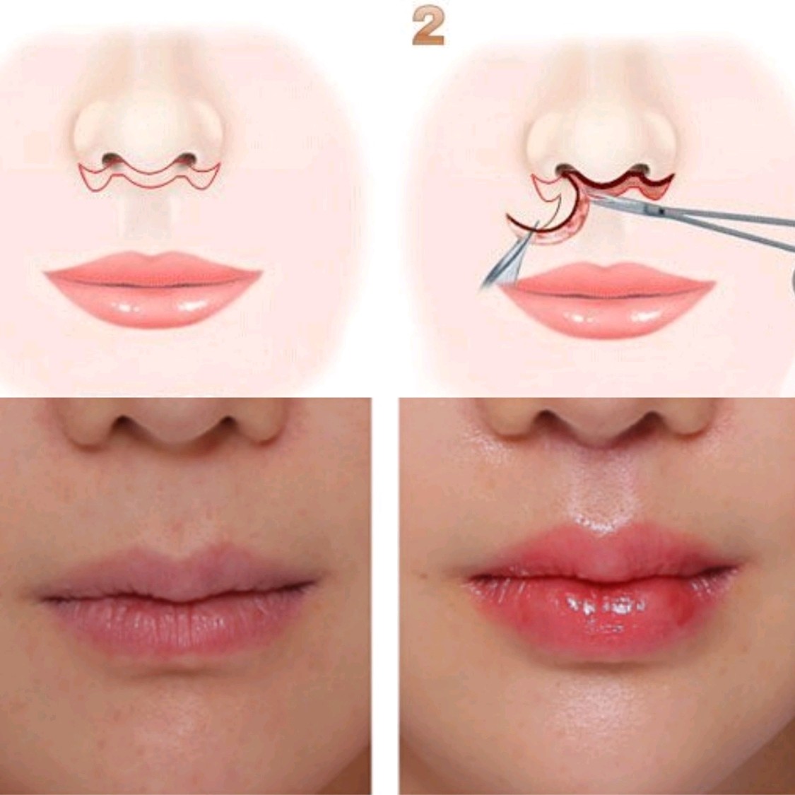 忽视的bug——人中60157415先问问大家_圈子-新氧美容整形