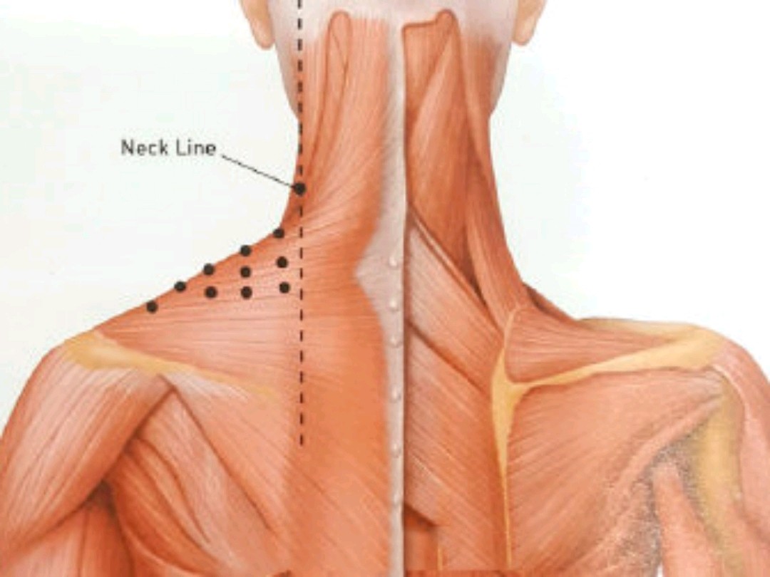 斜方肌,是将头部和颈部往后拉的背部肌肉,如果太发达_圈子-新氧美容