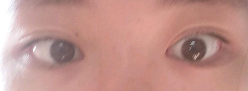 有些斗鸡眼 内眼白少 外眼白多 眼睛 新氧美容整形