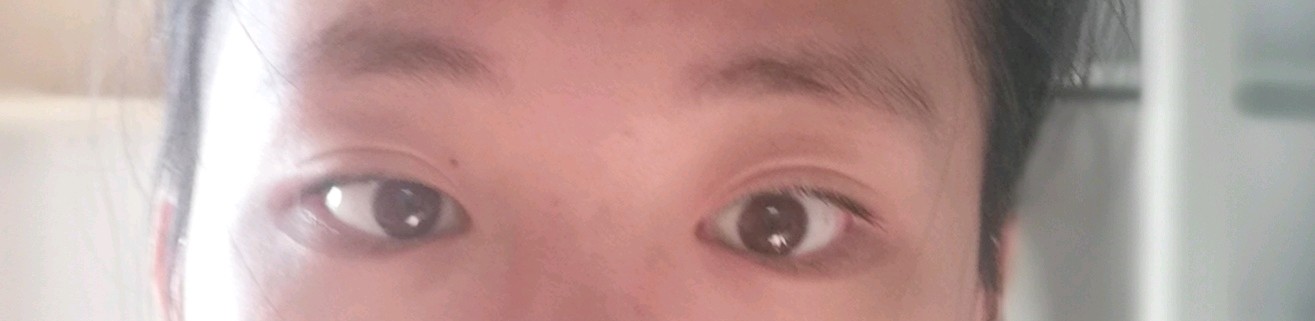 有些斗鸡眼 内眼白少 外眼白多 眼睛 新氧美容整形