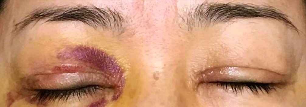 双眼皮全切已8天右眼褶皱不在刀口处请帮忙看看否失败了能自己恢复吗