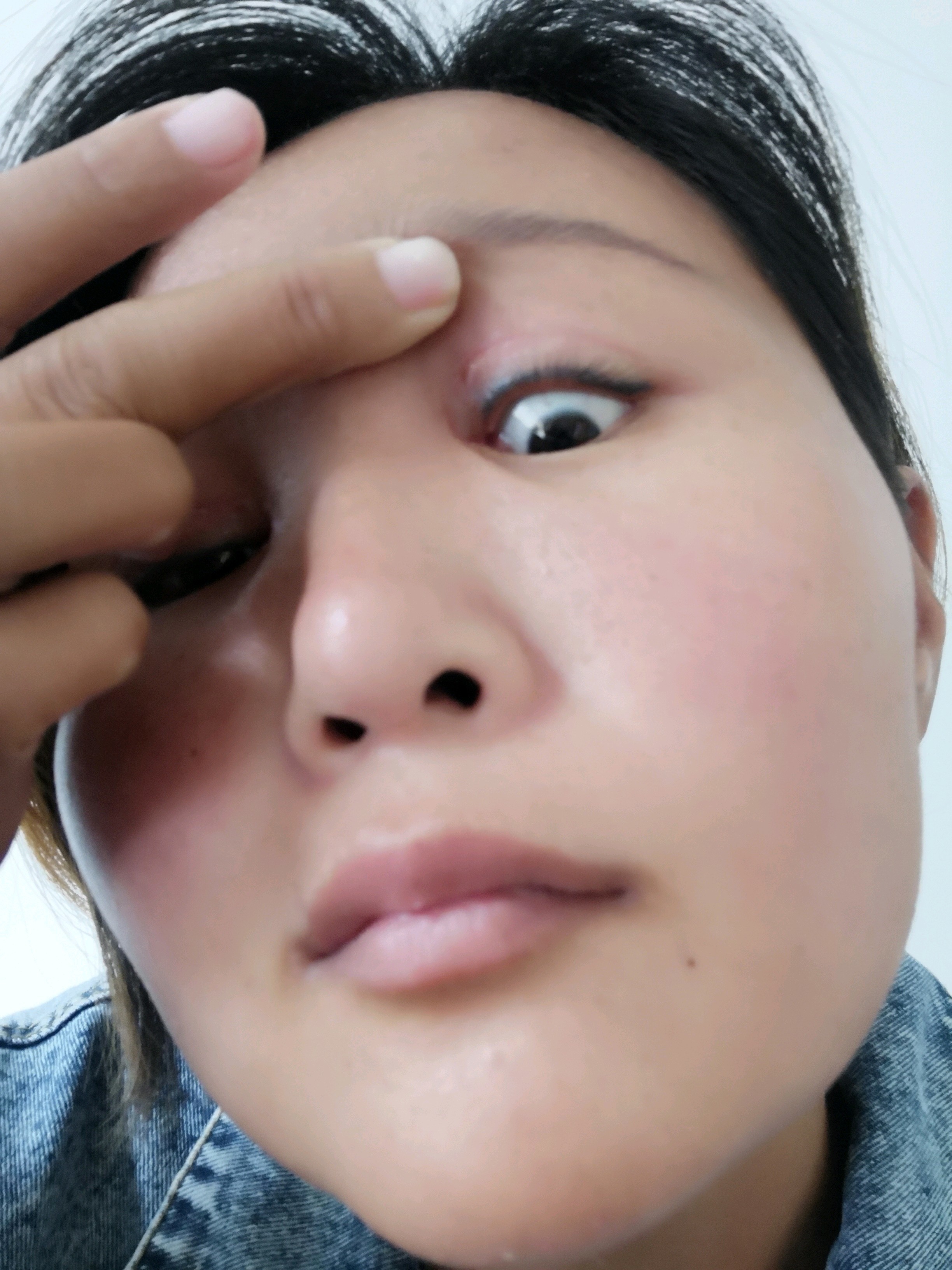 双眼皮第14天右眼角里面起了个脂肪粒磨的眼球通红像沙子粒一样