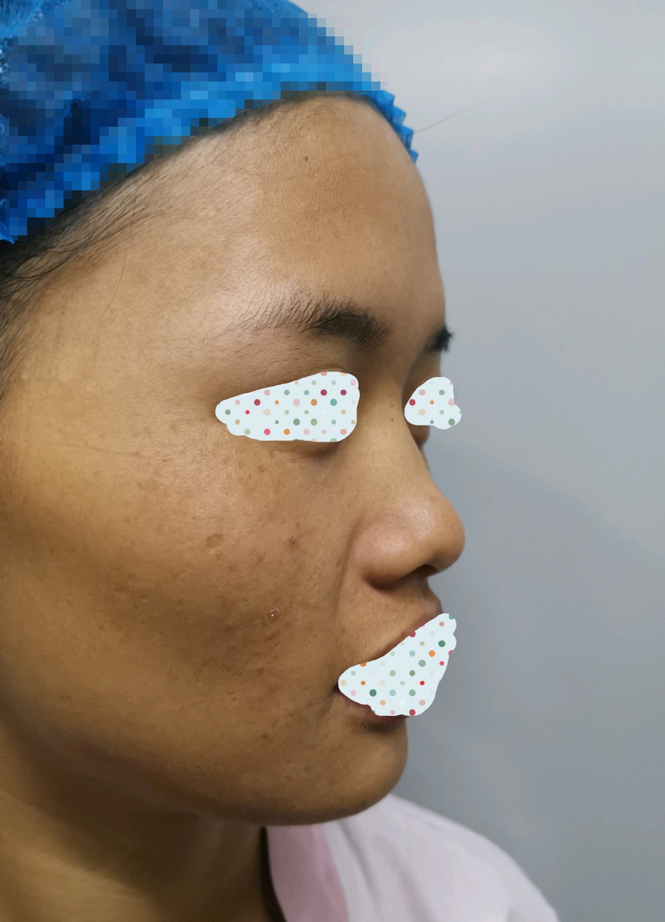 鼻头鼻翼大,鼻头塌,很容易缺乏精致感,自然影响面部_圈子-新氧美容